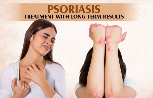 Ayurvedic Treatment of Psoriasis